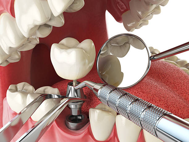 Best Emergency Tooth Extraction in La Grange, IL